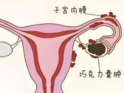 巧克力囊肿：卵巢里的