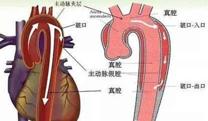 主动脉夹层手术患者出院后的居家护理