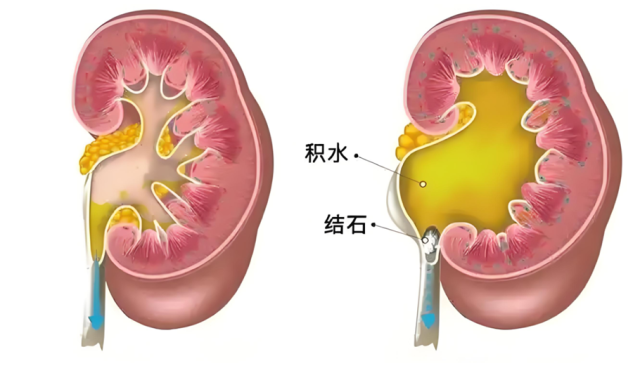 肾积水可能悄悄伤害孩子肾脏!家长如何早发现与科学干预?