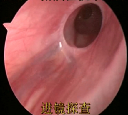 拿捏“淘气包”——小儿疝气