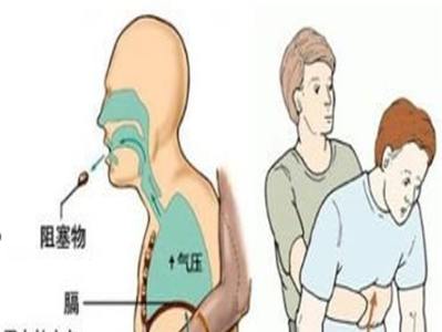 误食异物怎么办？急诊急救黄金法则要牢记