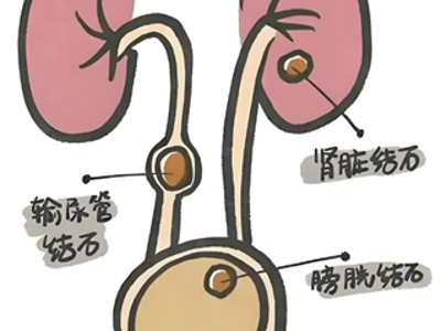 尿道结石到底该不该手术？