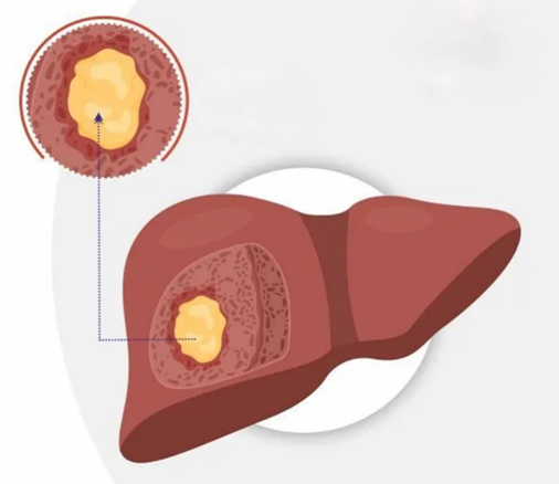 肝脓肿:沉默的“肝脏危机”