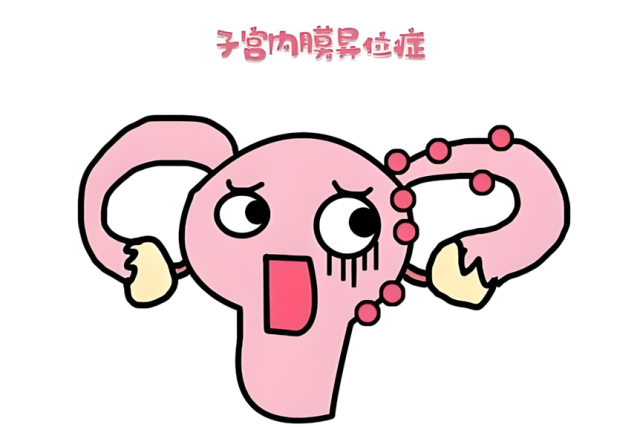 当姨妈变成暴脾气:揭秘子宫内膜异位症