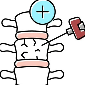 骨松骨折别害怕!微创经皮椎体成形术了解一下
