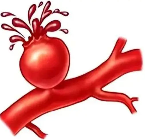 血管炸弹拆解手册:动脉瘤患者的日常防爆指南