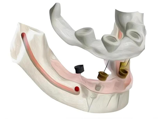 种牙像搭乐高?揭秘数字化种植牙的像素级精准