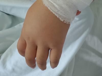 骨折后总肿成“发面馒头”？3个消肿小技巧护士都在用！