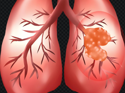 肺结节随访期间，这些身体信号必须就医！