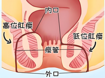 肛瘘：肛门周围的异常“通道”之谜