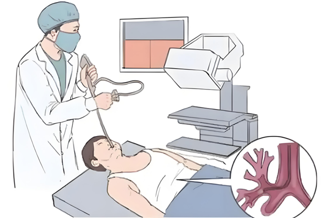 睡一觉就做完检查?揭秘无痛气管镜的
