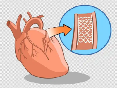 心脏放了支架，就可以高枕无忧？这5个“隐形杀手”仍需警惕
