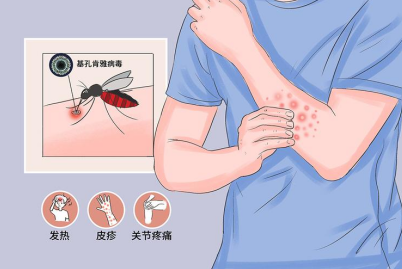 校园基孔肯雅热也可防,这些知识来收藏!