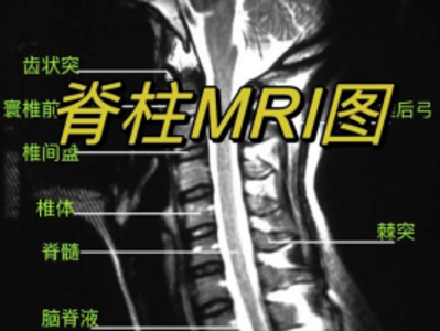 脊柱的年轮：解码你的脊柱磁共振报告单