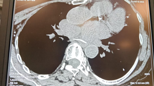 误吞异物怎么办?影像检查来帮忙