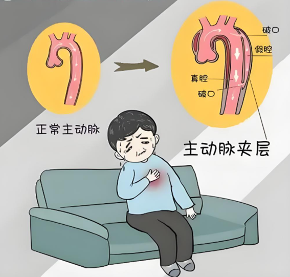 拆弹家族的必修课:当家人突发主动脉夹层该怎么做?