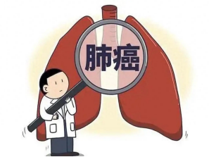 肺癌的早期信号,别让