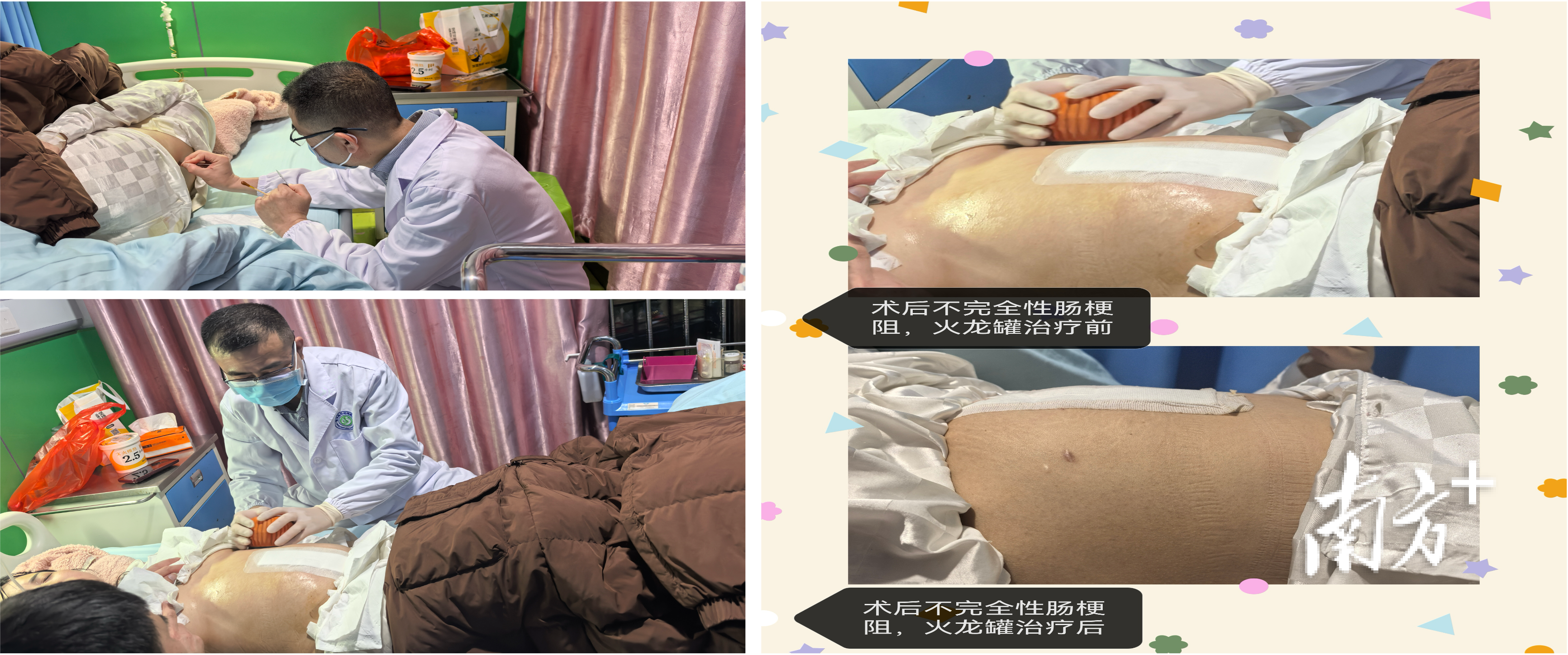 中西医结合科治疗师梁鲁波用针刺结合火龙罐综合灸疗法，缓解腹腔术后不完全性肠梗阻患者腹痛腹胀症状。 市一医院供图