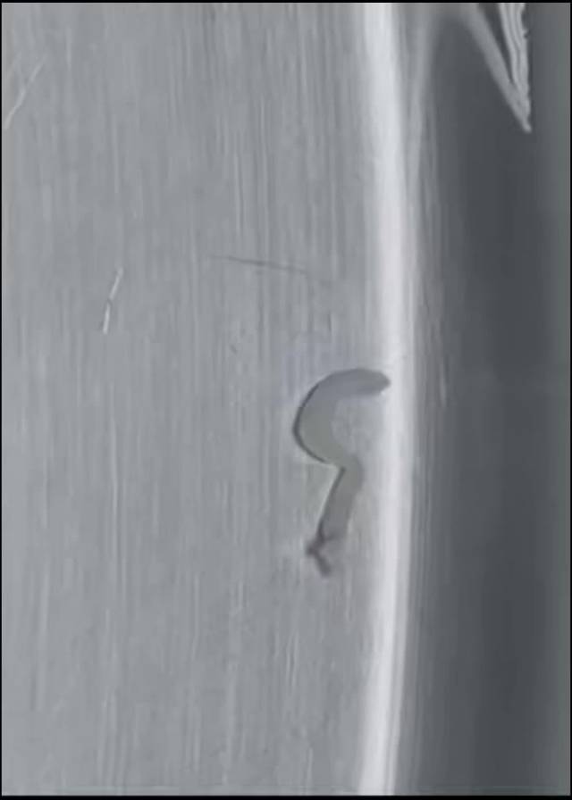 男子脑内取出10厘米裂头蚴,医生提醒:不吃生食、不喝生水