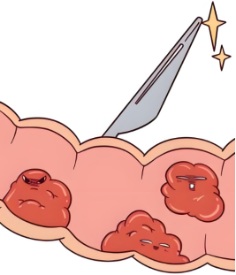 从肠息肉到肠癌要走“5步路”,第3步前切掉完全能“踩刹车”!