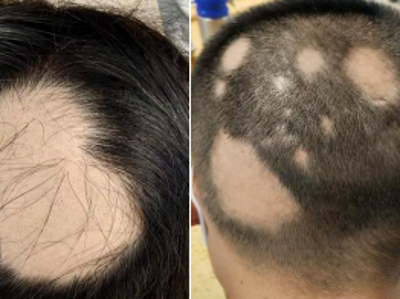 告别 “突然脱发” 的焦虑 ，斑秃科学科普指南