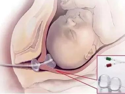 全面了解球囊引产：分娩的得力助手与科学护理