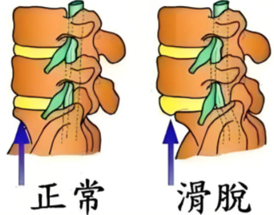 为什么年轻人也会腰脱？这个“隐形杀手”不能忽视