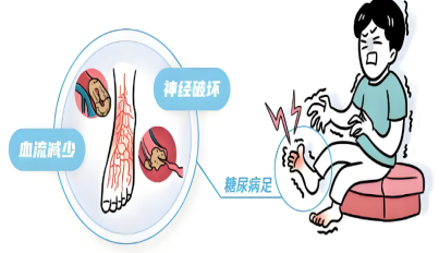 糖尿病神经病变的早期信号：可辨、可防、可控