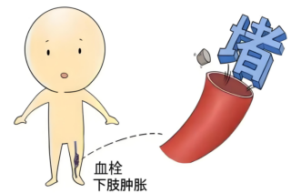 VTE可防可治！妇科护士带您读懂血栓的“前世今生”