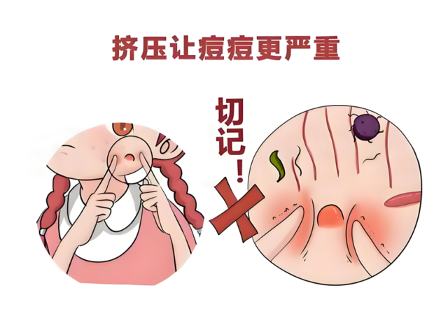 痤疮治疗新攻略，战“痘”不再愁