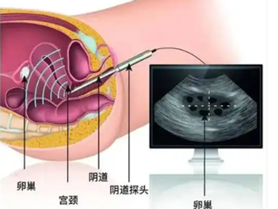 妇科检查中的腔内三维超声，你了解多少？