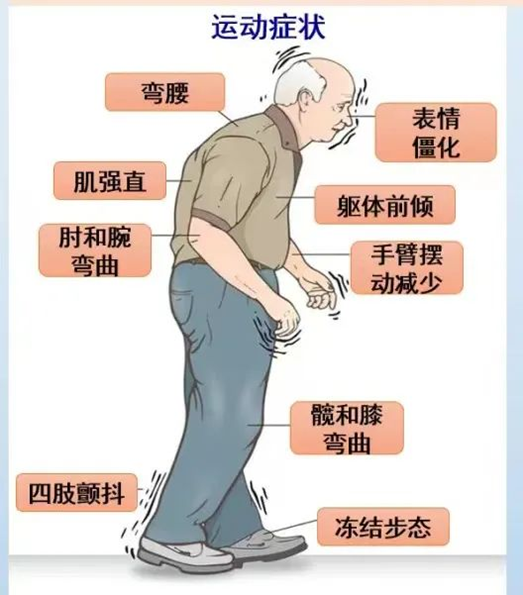 走路的姿态是大脑的“晴雨表”：从步态看帕金森