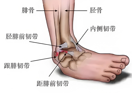 崴脚后肿成馒头？别揉！区分韧带拉伤和骨折的小窍门