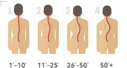 青少年脊柱侧弯的早期识别与黄金干预期