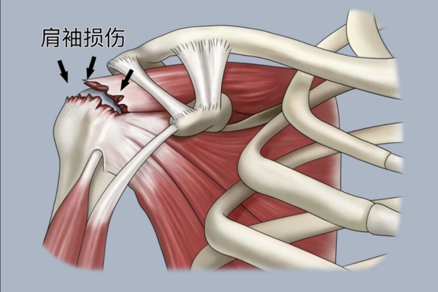 肩膀的小宇宙与维稳团队：认识肩袖与损伤根源