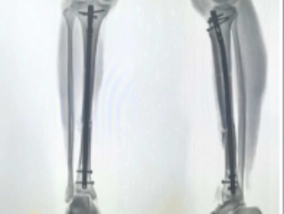 髓内钉固定：隐藏在骨头里的钢筋