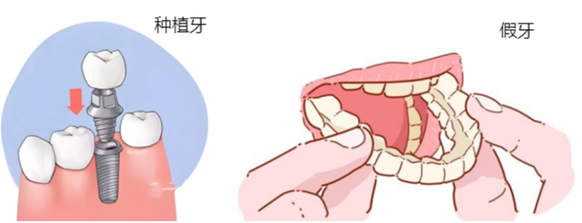 缺牙选种植牙还是假牙？口腔修复医生帮你对比选