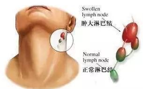 淋巴结肿大，是身体在求救！下面的预警信息千万别忽视！