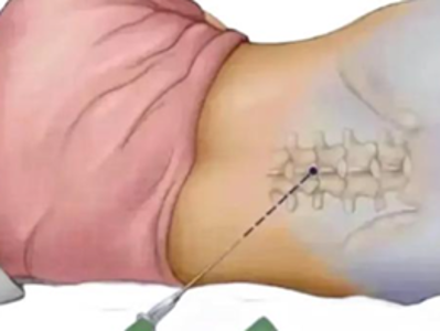 剖宫产术后腰痛是麻醉引起的吗？