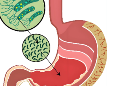 幽门螺杆菌：住在胃酸里的钉子户