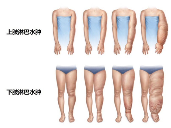 肢体淋巴水肿的综合治疗