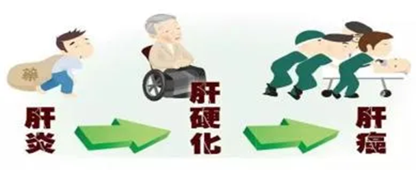 脂肪肝绝非“小毛病”，严重时可能引发重症危机