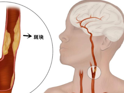 颈动脉斑块：大脑“生命主干道”上的不定时炸弹