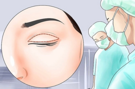 内双、肿眼泡能割双眼皮吗？医生：要先评估