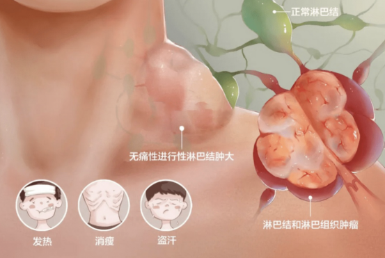 淋巴瘤偏爱年轻人？这些“无痛肿块”信号千万别忽视