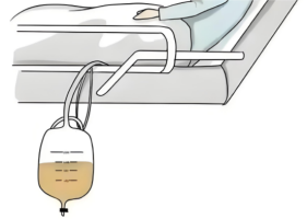 宫颈癌术后带尿管出院的居家护理