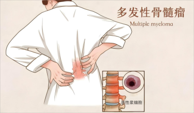 中老年人这些骨痛信号，须警惕多发性骨髓瘤