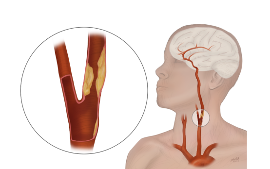 颈动脉狭窄支架置入术：微创解决“血管堵塞”的妙招！