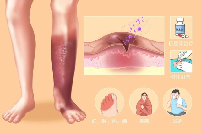 ICU护士为您揭秘蜂窝织炎的隐匿风险
