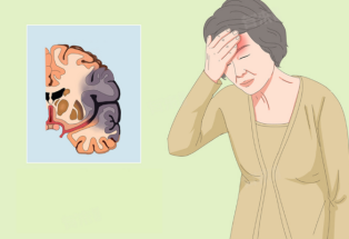 缺血性脑卒中咋预防？4个日常习惯能降低风险